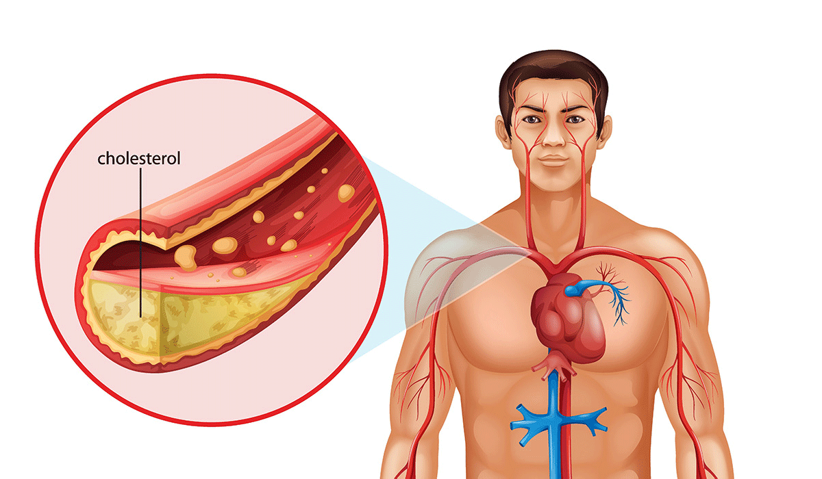 Cholesterol